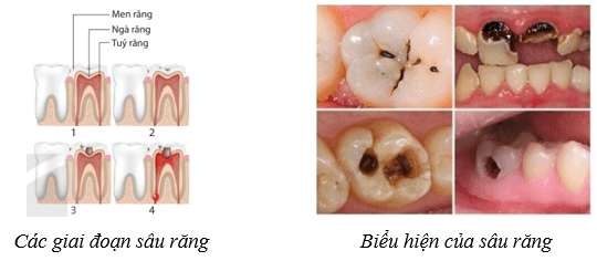 Dinh dưỡng và tiêu hóa ở người (KHTN 8 Kết nối tri thức Bài 32)