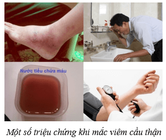 Hệ bài tiết ở người (KHTN 8 Kết nối tri thức Bài 35)