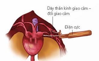 Buộc chỉ ngăn cách xoang tĩnh mạch với tim